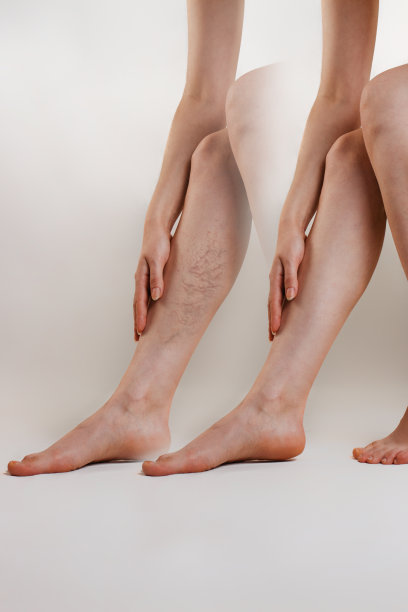 医学和健康。女性静脉曲张的概念。一个女人用脉管星摩擦她疲惫的腿。之前和之后。本空间图片下载