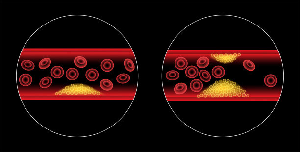 胆固醇和动脉粥样硬化图片下载