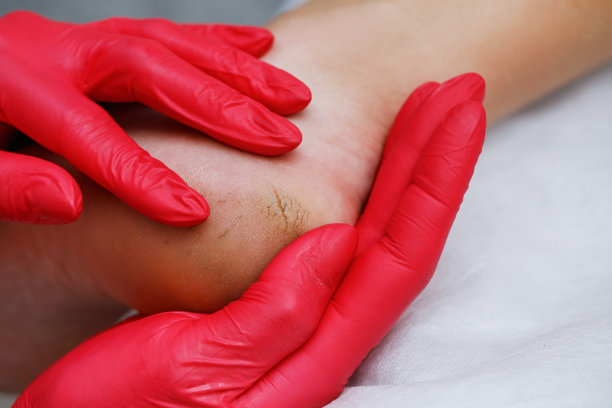 脚后跟皮肤干燥，皲裂疼痛。图片下载