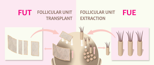 毛发移植的方法以信息图为例。图片下载