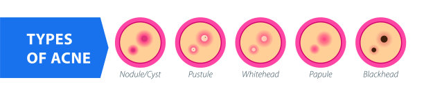 痤疮的类型，病因，治疗。信息图的粉刺。图片下载