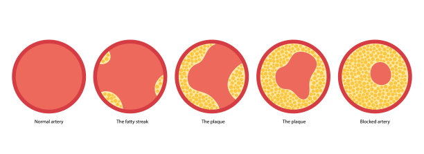 胆固醇和动脉粥样硬化图片下载