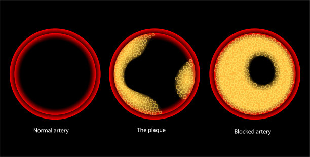 胆固醇和动脉粥样硬化图片下载