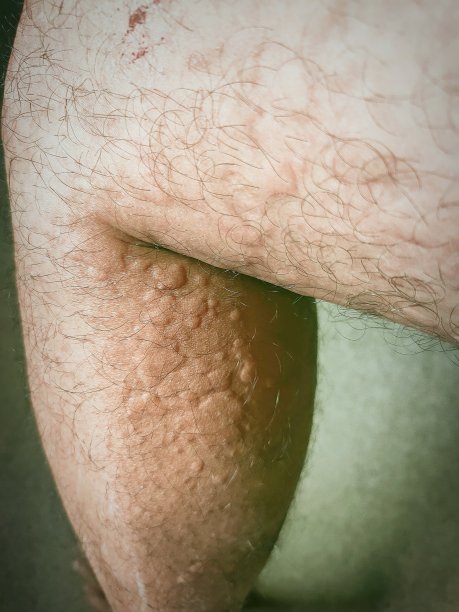 伴有瘙痒的皮肤荨麻疹需要药物治疗。图片下载