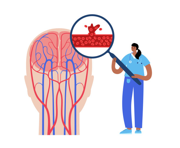 大脑出血性中风图片下载