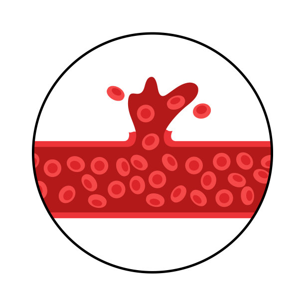 大脑出血性中风图片下载