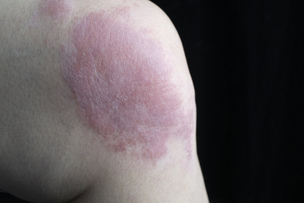 膝盖过敏图片下载