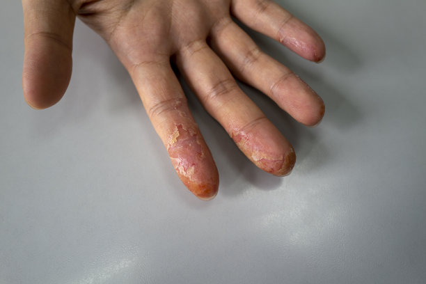 手指脱皮图片下载