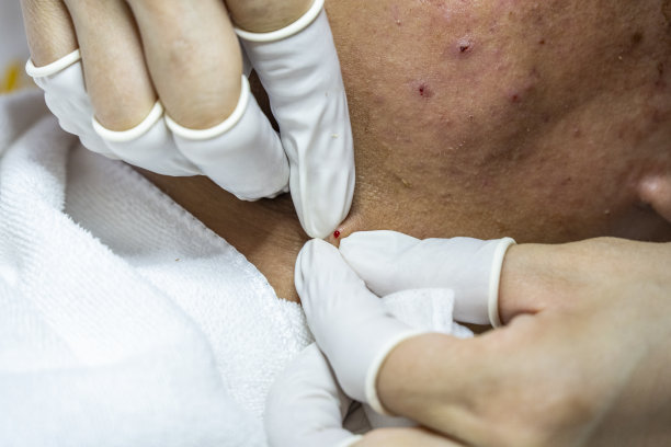 美容师正在治疗痤疮图片下载