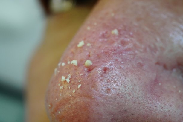 丘疹在鼻子图片下载