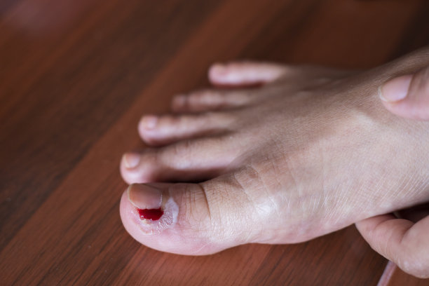 脚趾甲烂了，脚上流血了图片下载