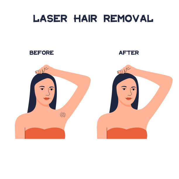 激光脱毛。脱毛前后。图片下载