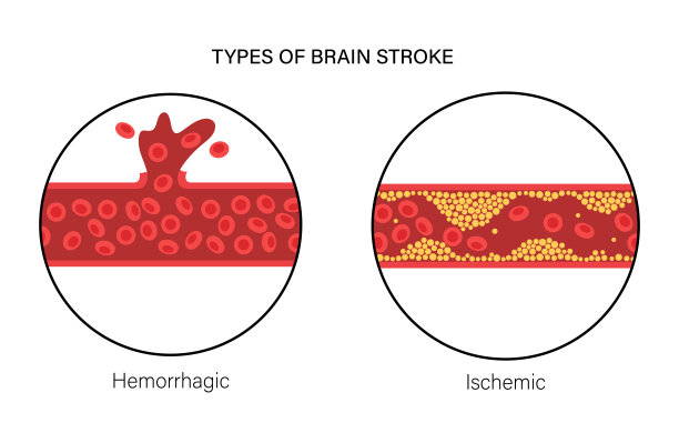 脑卒中和出血图片下载