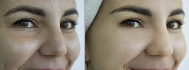 女性面部皱纹处理前后图片下载