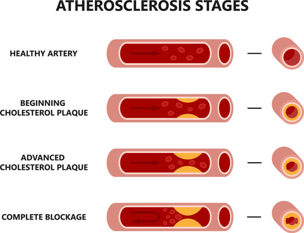 动脉粥样硬化形成健康和不健康图片下载