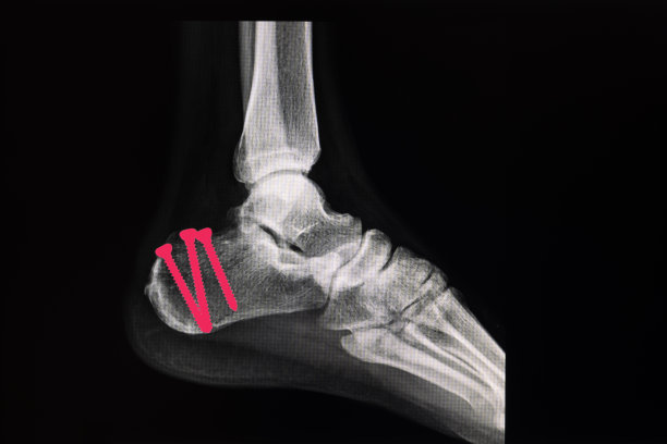 跟骨(跟骨)骨折患者足部x线片。图片下载