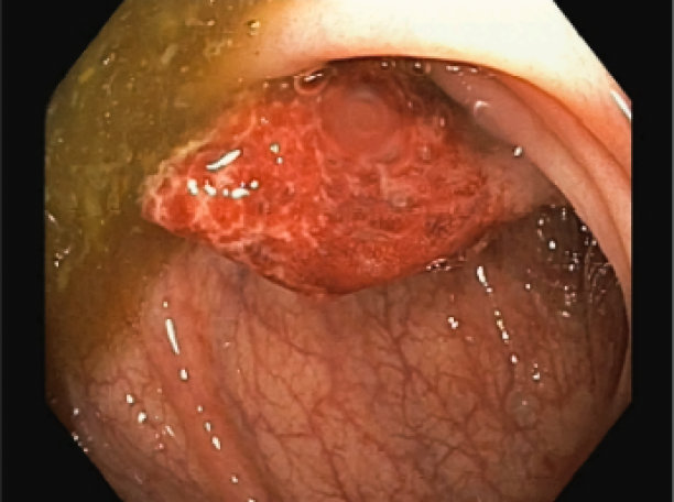 息肉切除术的结肠镜图像，结肠息肉。痔疮的内外视图。图片下载