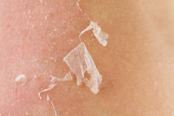 被太阳晒伤的皮肤。护肤和防紫外线的概念图片下载