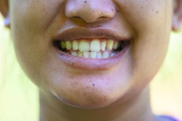 微笑的女人。张开嘴。看牙齿。看那些没有对齐的牙齿。没有魅力的微笑图片下载