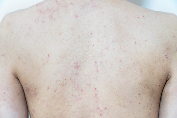 特应性/热疹/皮炎图像。一张皮肤粗糙的男人的照片。图片下载