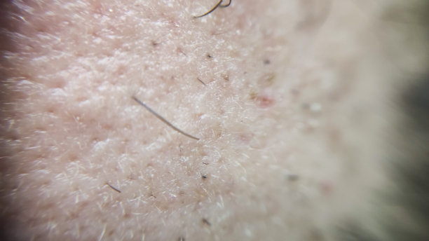 特写的白种人皮肤与内生长的头发和男子短胡子。特写白种人皮肤与许多内生毛发的概念图片下载