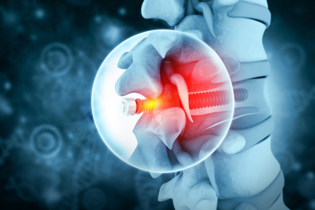 脊柱植入物，螺钉放置，3d图解图片下载