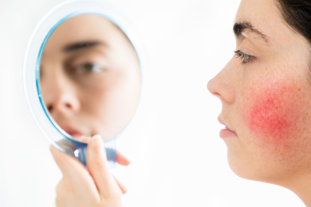 Couperose。年轻漂亮的白种人女人脸上有酒渣鼻看着镜子。孤立在白色背景上。美学医学和美容学的概念图片下载