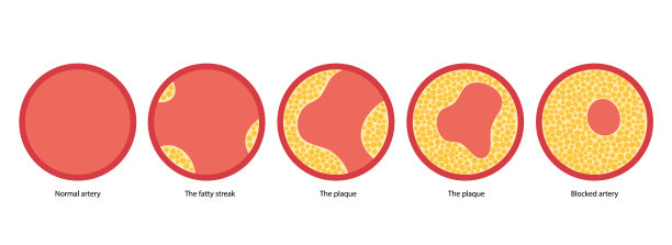 胆固醇和动脉粥样硬化图片下载