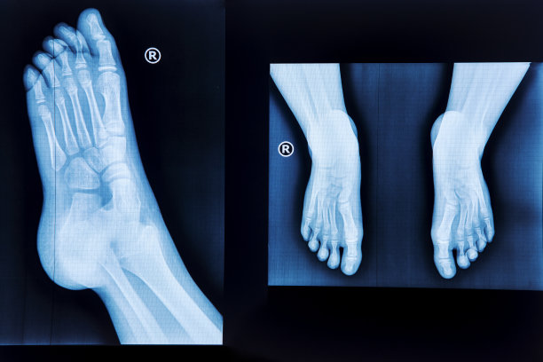 人脚x光片图片下载