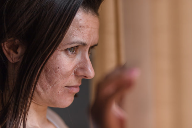 近距离照片的女人干燥的皮肤看在窗口。图片下载