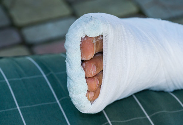 白色石膏石膏的断腿搁在绿色方格枕头上。特写男人的腿和手指。从台阶上摔下来后腿部骨折。那条腿翻了起来摔断了图片下载