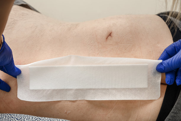 护士手补痣摘除手术切口为表皮胎记概念图片下载