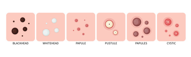 类型的痤疮。皮肤上的痤疮和脸上的粉刺。向量图标上的痤疮皮肤。图片下载