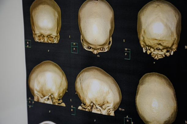 颅骨断层扫描人类头部。图片下载