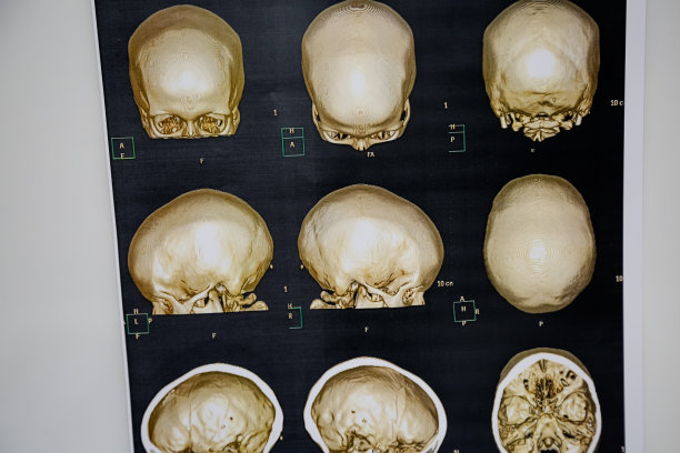 颅骨断层扫描人类头部。图片下载