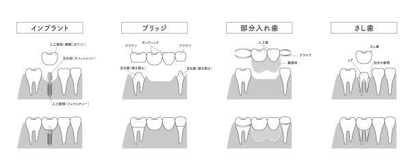 种植桥可摘局部义齿对比图图片下载