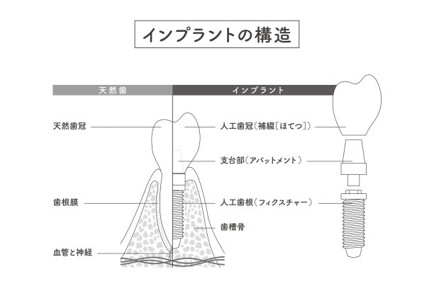植入物的结构说明图片下载