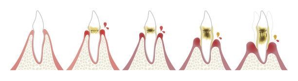 牙周病进展的图示图片下载