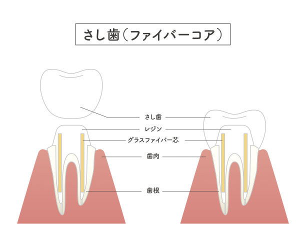镶齿结构说明图片下载