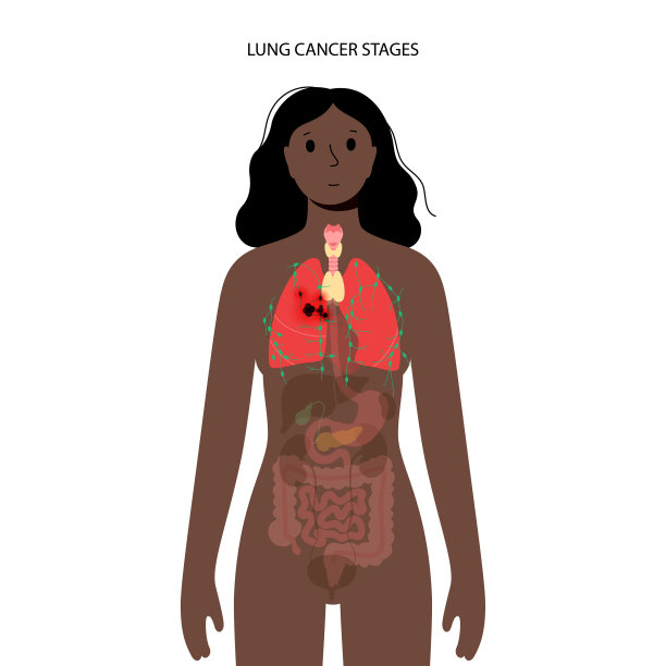 肺部肿瘤疾病图片下载
