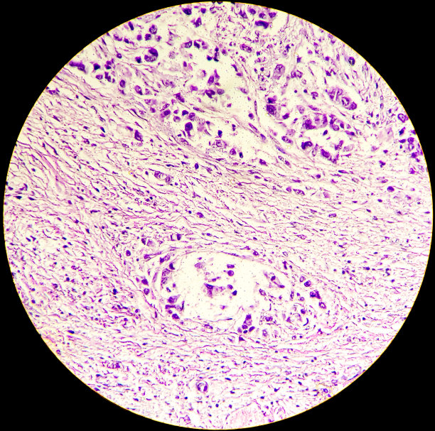 显微照片显示胆囊腺癌。胆囊癌，分化良好的腺癌图片下载