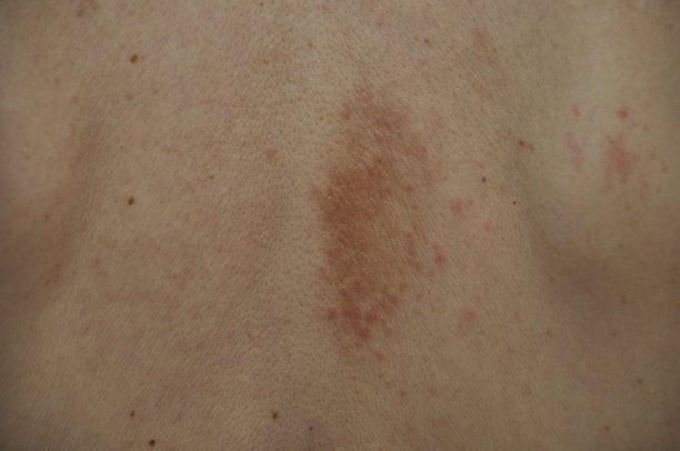 背上有湿疹丘疹图片下载