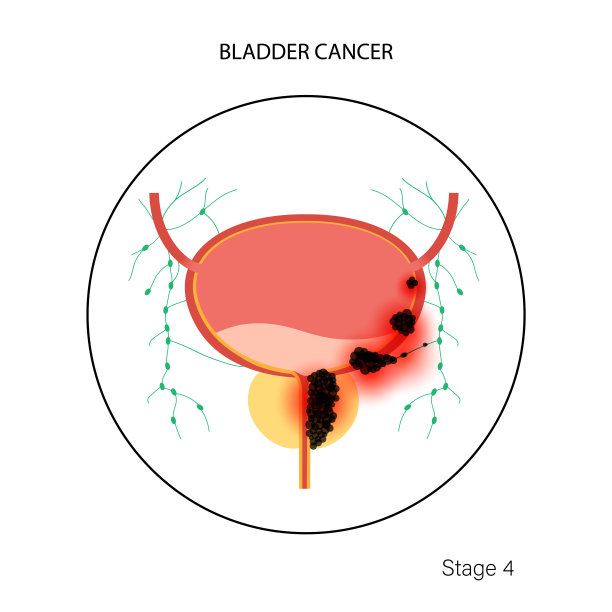膀胱癌阶段图片下载