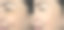 女性眼部皱纹治疗前后图片下载