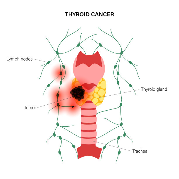 甲状腺癌阶段图片下载