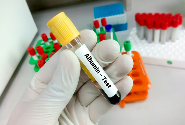 用于白蛋白检测的血液样管。肝病的诊断。低白蛋白血症,Hyperalbuminemia图片下载