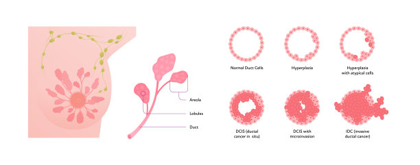 人类乳腺癌解剖图。矢量平面医学插图。前视图。分期疾病和肿瘤细胞分离在白色背景上。为医疗保健、科学、教育、肿瘤学设计。图片下载