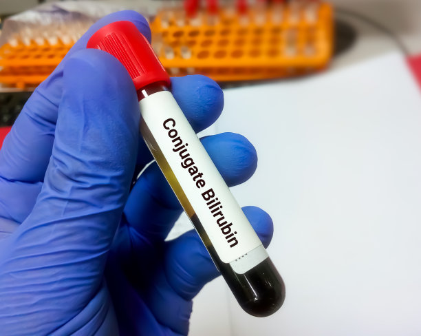科学家保存血液样本进行结合胆红素试验图片下载