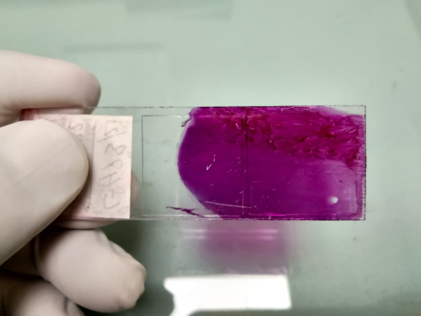 在医学实验室，组织病理学家手持显微镜下的巴氏染色玻片进行FNAC、细针抽吸细胞学检查。用于诊断腺癌或癌细胞。图片下载