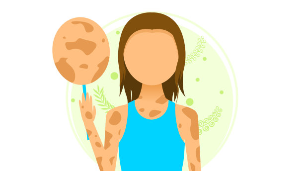 Flat Girl Woman Character remove The Mask With Spots白癜风脱色病矢量设计风格概念人是平等的图片下载